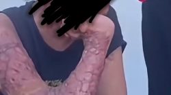 Dirut RSUP NTB: Pengobatan Ditanggung LPA, Tidak Ditanggung BPJS