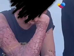 Dirut RSUP NTB: Pengobatan Ditanggung LPA, Tidak Ditanggung BPJS